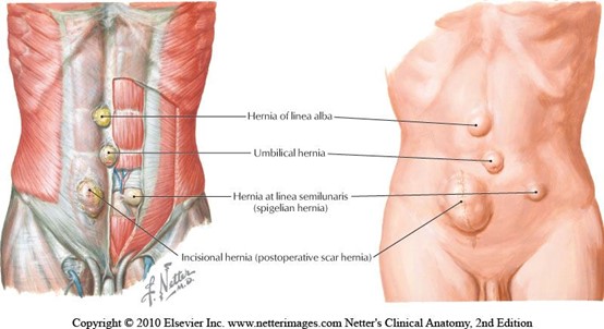 Hernia