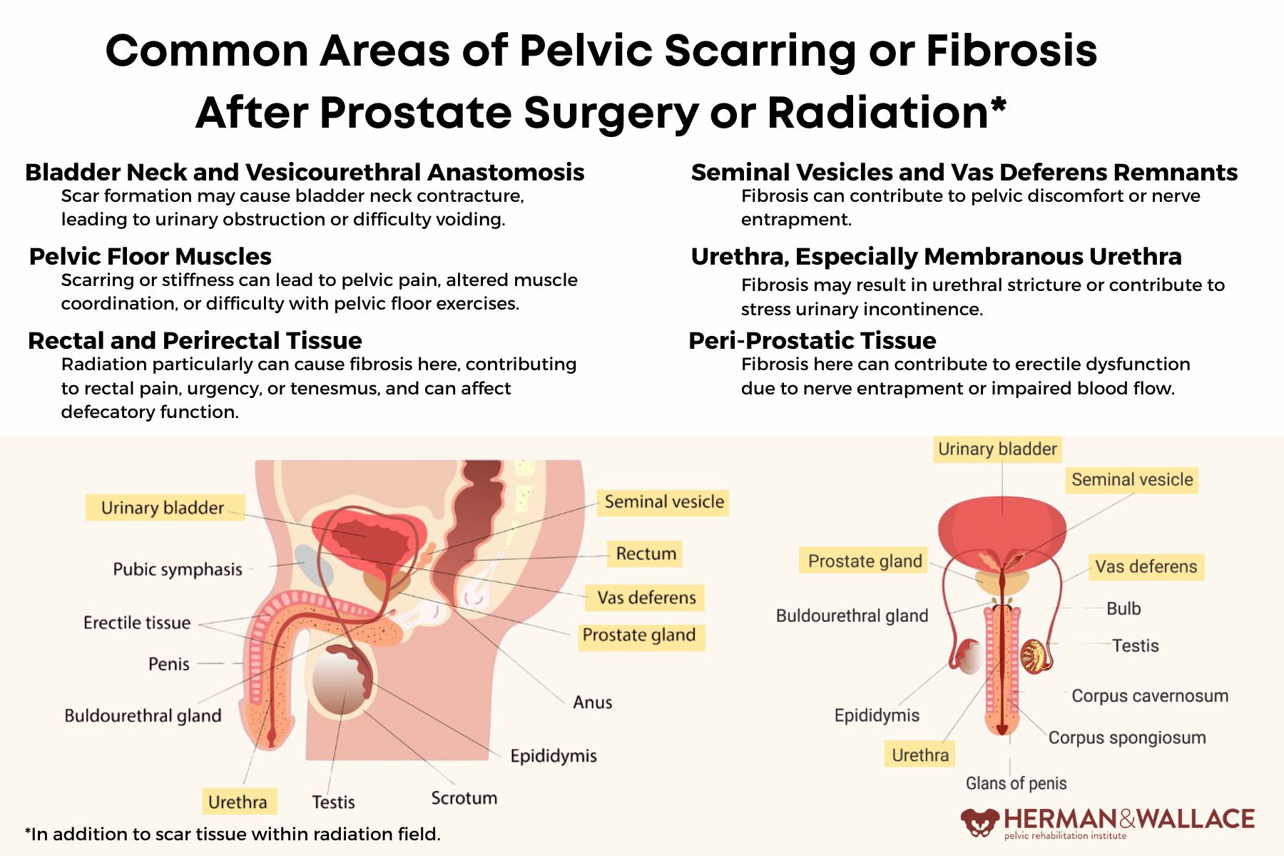 OPF2A Areas of Pelvic Scarring After Prostate Surgery 10.21.25