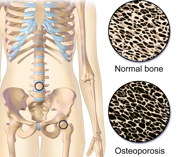 Do You Know the Top 3 Signs of Osteoporosis?