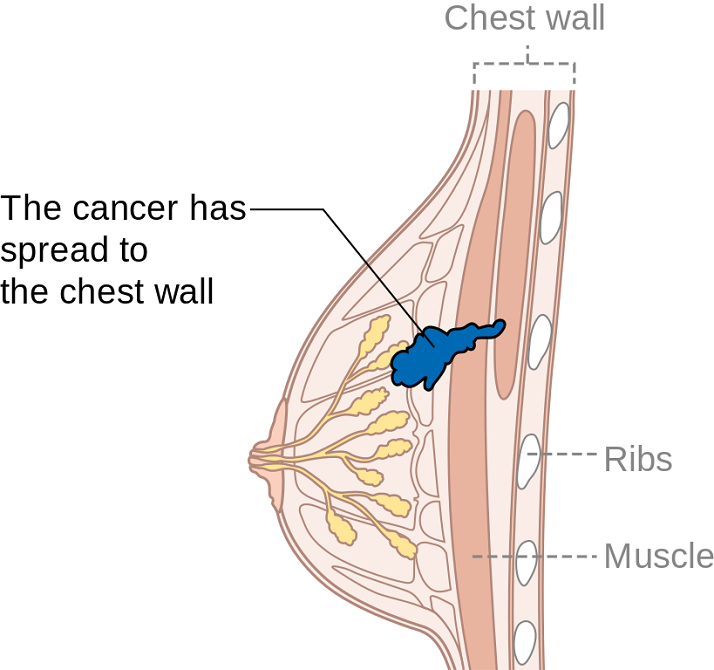 Breast Oncology: Not “One-Size-Fits-All” Rehab