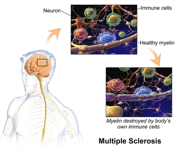 Multiple Sclerosis: Dealing with Bowel Dysfunction
