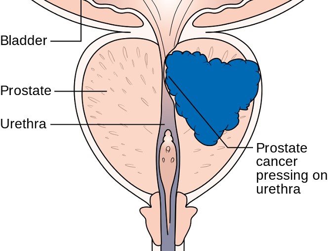 ProstateCancer_Urethra.jpg