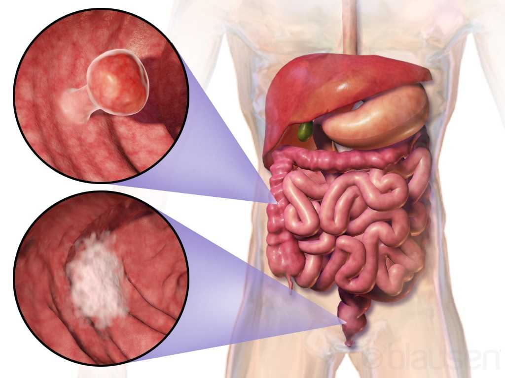 Colorectal Cancer: Complications after the Cure