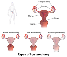 Are Women Opting for Hysterectomies too Often?