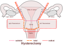 Rehabilitating Pelvic Floor Muscles after Cancer Treatment