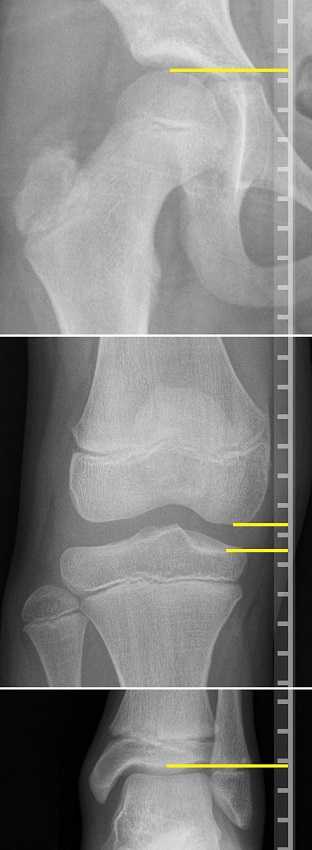 Screening for Leg Length Discrepancy