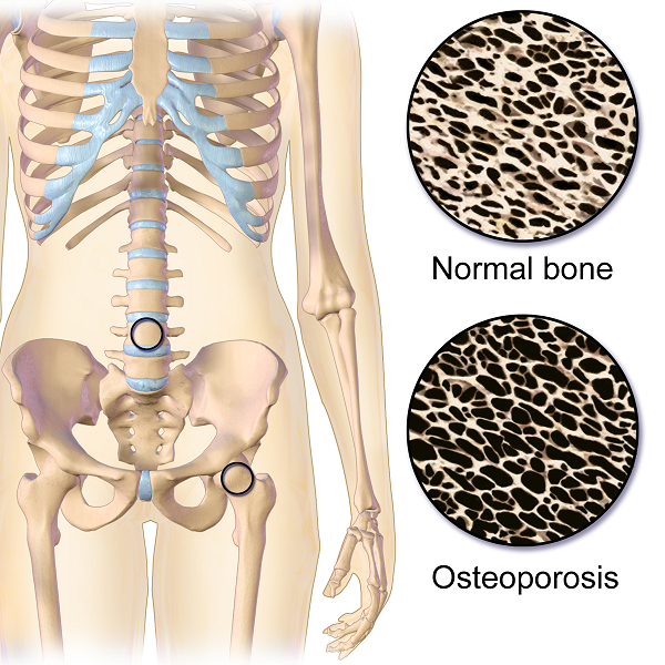 Osteoporosis