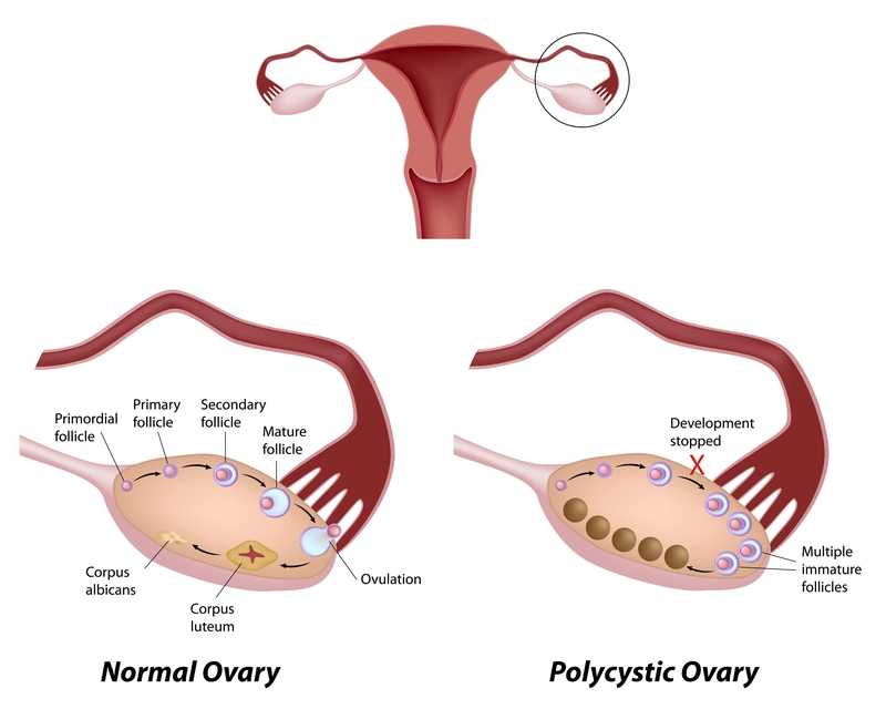 Early Detection of Polycystic Ovarian Disease Matters