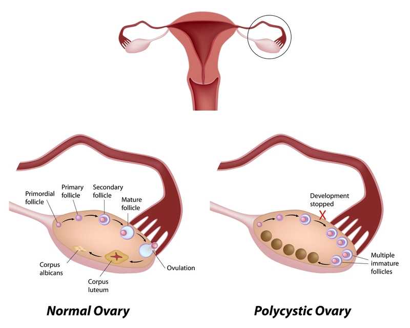 Polycystic Ovary Syndrome