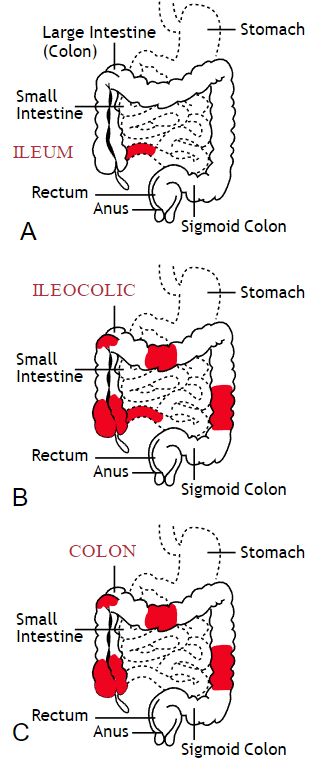 Physical Therapy Considerations for Patients with Inflammatory Bowel Disease