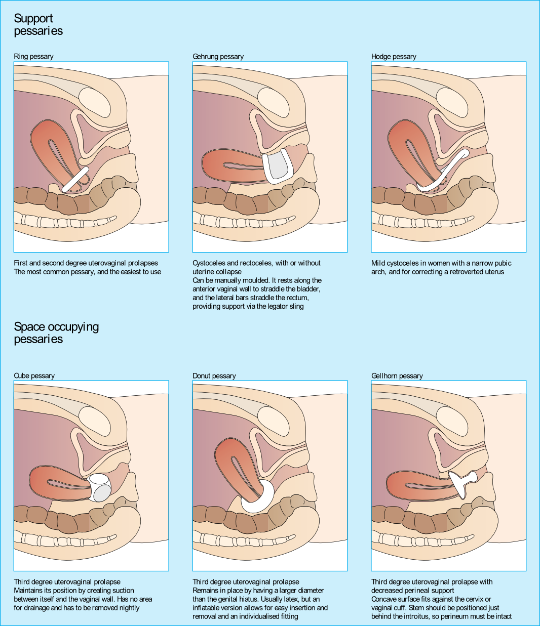 Pessary Use and Defecatory Dysfunction