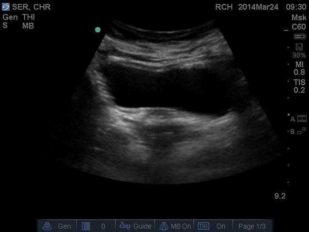 Using Transabdominal Ultrasound to Assess Pelvic Floor Muscle Activation