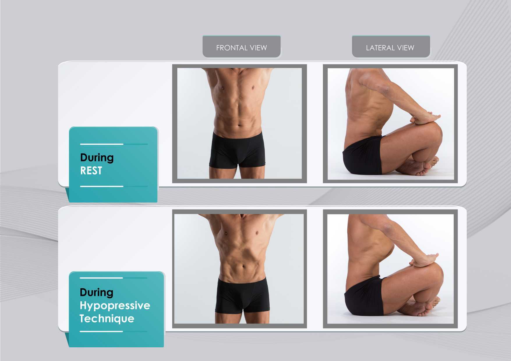 Hypopressive Exercise for Post-prostatectomy Incontinence